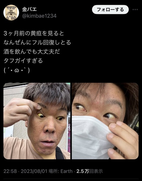 肝硬変で死にそうになってる金バエさんの生態　医者にドン引きされる「医者になって1番の学びは、本当の弱者は皆が救いたいような姿をしてないってことやなあ。」